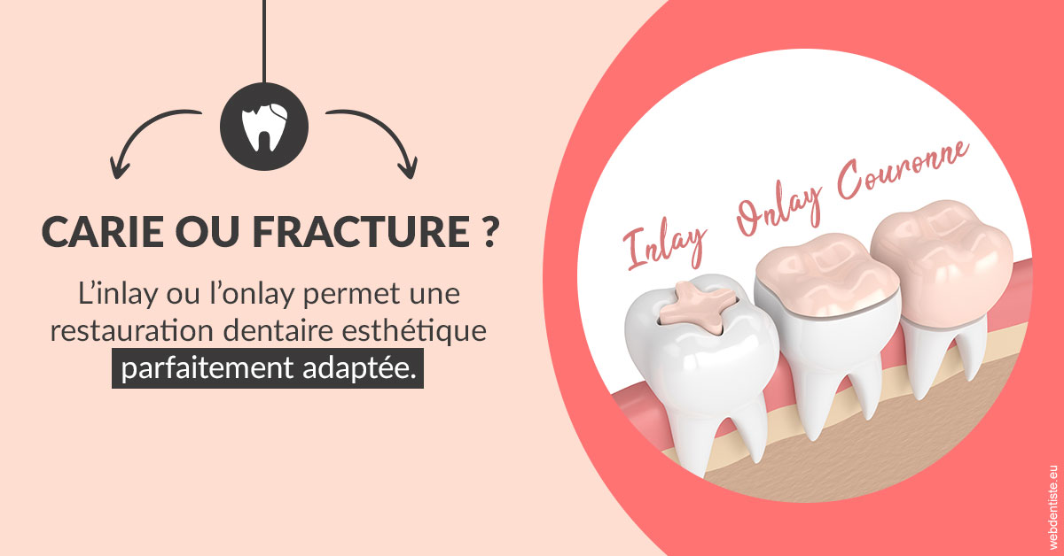 https://dr-valerie-travert.chirurgiens-dentistes.fr/T2 2023 - Carie ou fracture 2