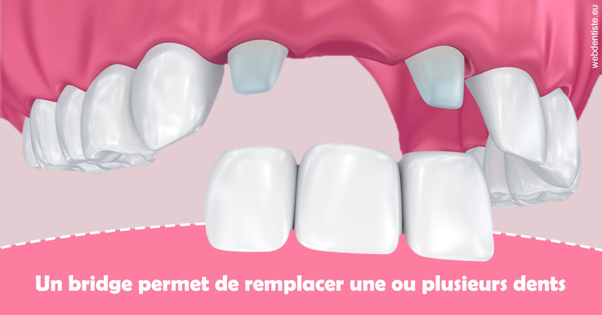 https://dr-valerie-travert.chirurgiens-dentistes.fr/Bridge remplacer dents 2