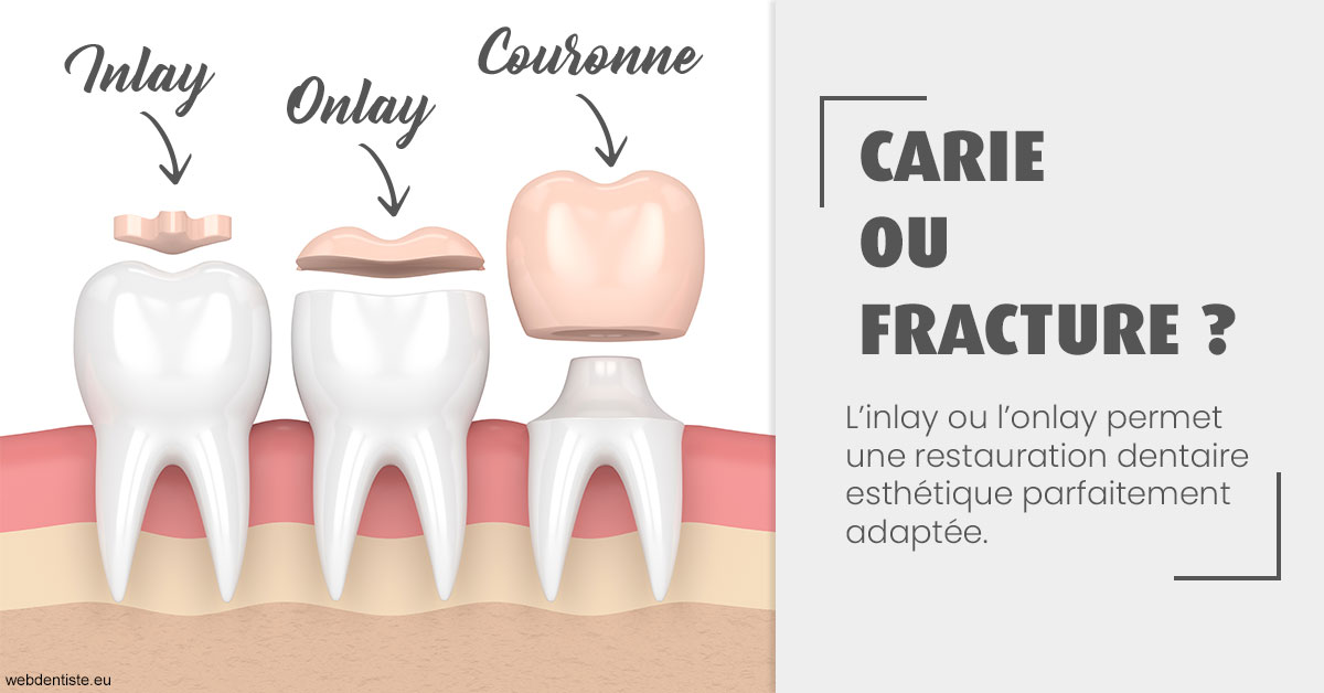 https://dr-valerie-travert.chirurgiens-dentistes.fr/T2 2023 - Carie ou fracture 1