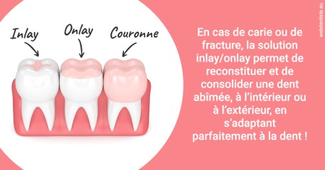 https://dr-valerie-travert.chirurgiens-dentistes.fr/L'INLAY ou l'ONLAY 2