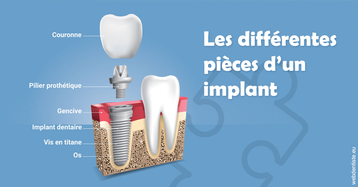 https://dr-valerie-travert.chirurgiens-dentistes.fr/Les différentes pièces d’un implant 1